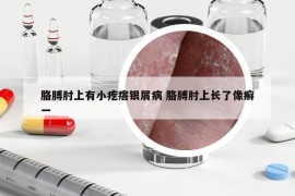 胳膊肘上有小疙瘩银屑病 胳膊肘上长了像癣一