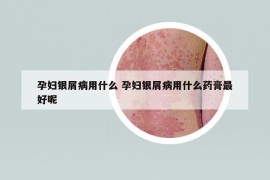 孕妇银屑病用什么 孕妇银屑病用什么药膏最好呢