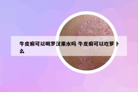 牛皮癣可以喝罗汉果水吗 牛皮癣可以吃萝卜么