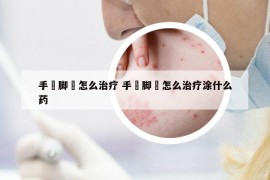 手廯脚廯怎么治疗 手廯脚廯怎么治疗涂什么药