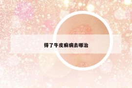 得了牛皮癣病去哪治