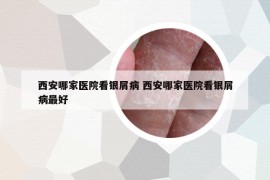 西安哪家医院看银屑病 西安哪家医院看银屑病最好
