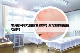 银屑病可以吃醋酸泼尼松吗 点滴型银屑病能吃醋吗