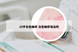 29岁白色糠疹 白色糠疹难治吗