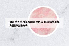 银屑病可以用复方酮康挫洗头 银屑病能用复方酮康唑洗头吗