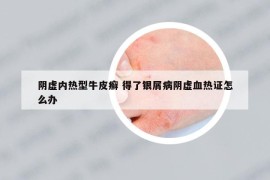 阴虚内热型牛皮癣 得了银屑病阴虚血热证怎么办