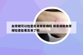 血常规可以检查出来银屑病吗 银屑病做血常规检查能看出来了吧