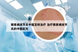 银屑病关节炎中医怎样治疗 治疗银屑病关节炎的中医配方