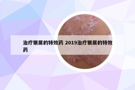 治疗银屑的特效药 2019治疗银屑的特效药