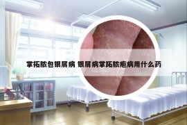 掌拓脓包银屑病 银屑病掌跖脓疱病用什么药