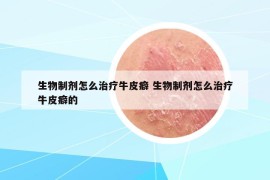 生物制剂怎么治疗牛皮癖 生物制剂怎么治疗牛皮癖的