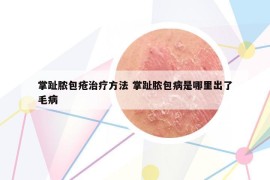 掌趾脓包疮治疗方法 掌趾脓包病是哪里出了毛病