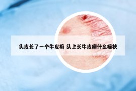 头皮长了一个牛皮癣 头上长牛皮癣什么症状