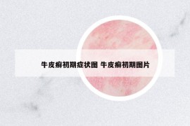 牛皮癣初期症状图 牛皮癣初期图片