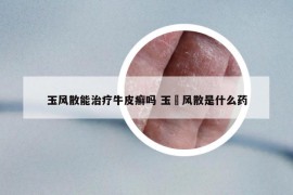 玉风散能治疗牛皮癣吗 玉屛风散是什么药