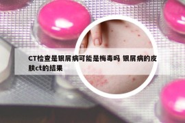 CT检查是银屑病可能是梅毒吗 银屑病的皮肤ct的结果