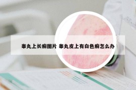 睾丸上长癣图片 睾丸皮上有白色癣怎么办