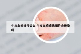 牛皮血癣症传染么 牛皮血癣症状图片会传染吗