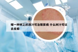哪一种树上的液汁可治银屑病 什么树汁可以去皮癣