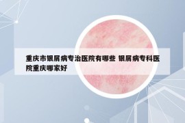 重庆市银屑病专治医院有哪些 银屑病专科医院重庆哪家好