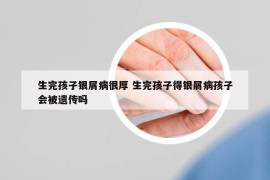 生完孩子银屑病很厚 生完孩子得银屑病孩子会被遗传吗