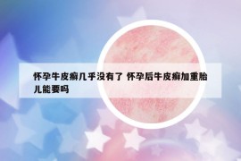 怀孕牛皮癣几乎没有了 怀孕后牛皮癣加重胎儿能要吗
