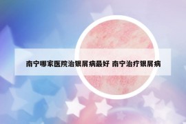 南宁哪家医院治银屑病最好 南宁治疗银屑病