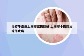 治疗牛皮癣上海哪家医院好 上海哪个医院治疗牛皮癣
