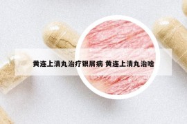 黄连上清丸治疗银屑病 黄连上清丸治啥