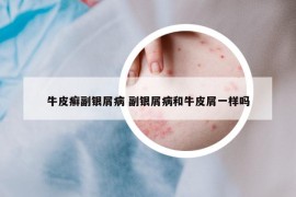 牛皮癣副银屑病 副银屑病和牛皮屑一样吗