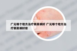 广元哪个地方治疗银屑病好 广元哪个地方治疗银屑病好些