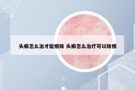 头癣怎么治才能根除 头癣怎么治疗可以除根