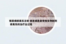 银屑病修美乐注射 银屑病患者使用生物制剂 修美乐的治疗全过程