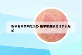 指甲有银屑病怎么办 指甲银屑病是什么引起的