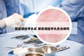 银屑病指甲头皮 银屑病指甲头皮会痒吗