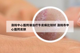 洛阳中心医院谁治疗牛皮癣比较好 洛阳市中心医院皮肤