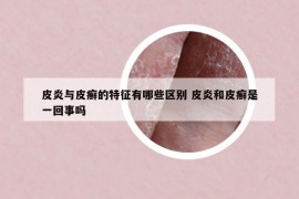 皮炎与皮癣的特征有哪些区别 皮炎和皮癣是一回事吗
