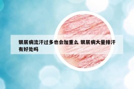 银屑病流汗过多也会加重么 银屑病大量排汗有好处吗
