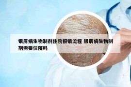 银屑病生物制剂住院报销流程 银屑病生物制剂需要住院吗