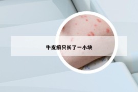 牛皮癣只长了一小块