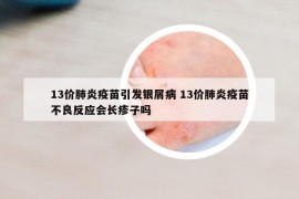 13价肺炎疫苗引发银屑病 13价肺炎疫苗不良反应会长疹子吗