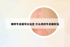 哪种牛皮癣可以治愈 什么样的牛皮癣好治
