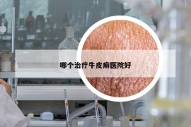 哪个治疗牛皮癣医院好