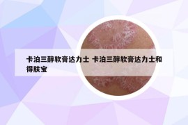 卡泊三醇软膏达力士 卡泊三醇软膏达力士和得肤宝