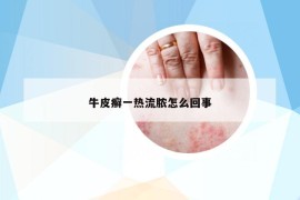 牛皮癣一热流脓怎么回事