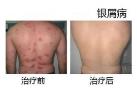 银屑病的发病原因有哪些呢