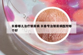 长春哪儿治疗银屑病 长春专治银屑病医院哪个好