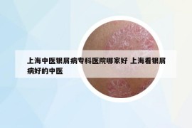 上海中医银屑病专科医院哪家好 上海看银屑病好的中医