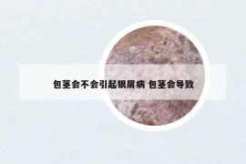 包茎会不会引起银屑病 包茎会导致