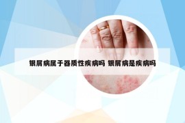 银屑病属于器质性疾病吗 银屑病是疾病吗